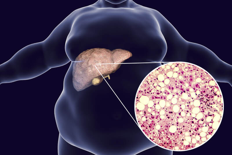 Homeopathic solutions for Liver Treatment